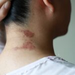 A,Wound,Of,Paederus,Dermatitis,,A,Peculiar,,Irritant,Contact,Dermatitis
